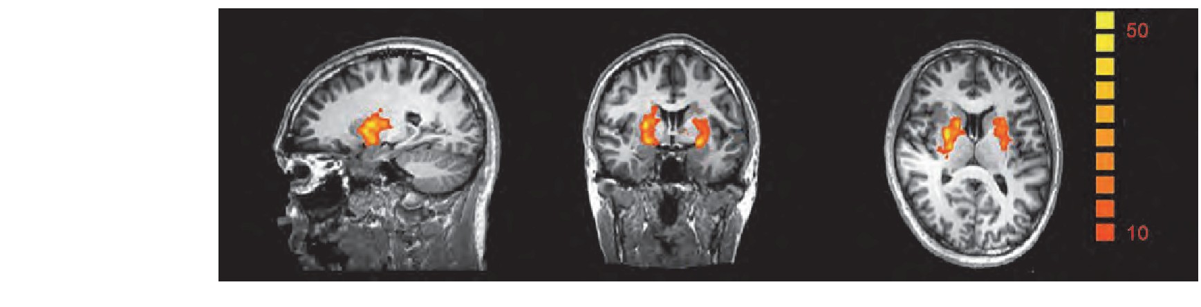 ͼ5 (ɫ) ȫԷЧӦŵ.FDRP0.05, voxel>200Figure 5 (Color online) Whole brain analysis results.FDR correction P0.05, voxel>200