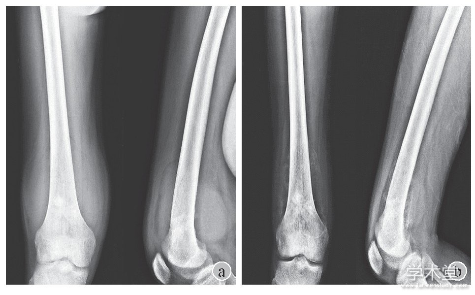 ͼ1 2߻ǰX߽Ƚa:ǰ;b:ƺFig.1 X-ray before and after chemotherapy (No.2) a:Before chemotherapy;b:After chemotherapy